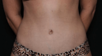Tummy Tuck Before & After Patient #29949