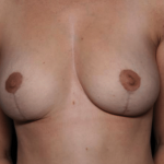 Breast Reduction Before & After Patient #29969