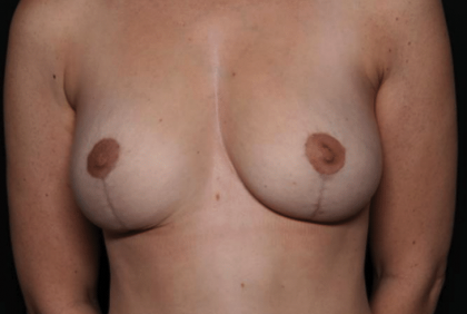 Breast Reduction Before & After Patient #29969