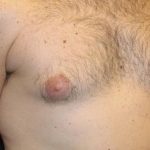 Gynecomastia Before & After Patient #30330