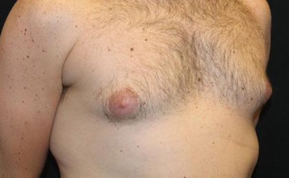 Gynecomastia Before & After Patient #30330