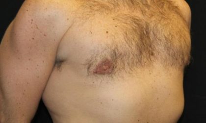 Gynecomastia Before & After Patient #30330