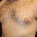 Gynecomastia Before & After Patient #30330