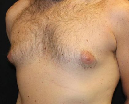 Gynecomastia Before & After Patient #30330
