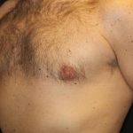 Gynecomastia Before & After Patient #30330