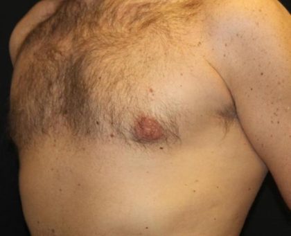 Gynecomastia Before & After Patient #30330