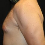 Gynecomastia Before & After Patient #30330