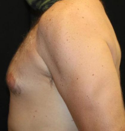 Gynecomastia Before & After Patient #30330