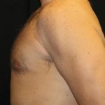 Gynecomastia Before & After Patient #30330