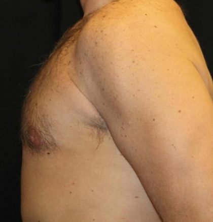 Gynecomastia Before & After Patient #30330