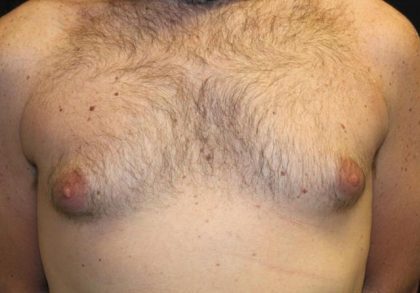 Gynecomastia Before & After Patient #30330