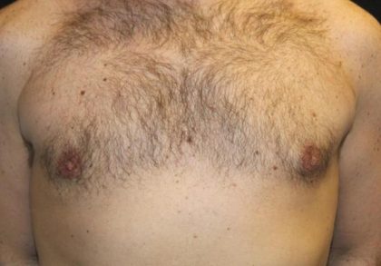 Gynecomastia Before & After Patient #30330