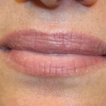 Lip Filler Before & After Patient #30316