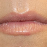 Lip Filler Before & After Patient #30298