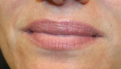 Lip Filler Before & After Patient #30316