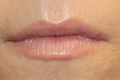 Lip Filler Before & After Patient #30298