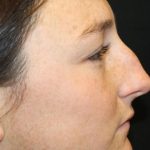 Rhinoplasty Before & After Patient #30305