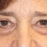 Blepharoplasty Before & After Patient #30271