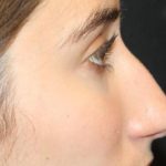 Rhinoplasty Before & After Patient #30321