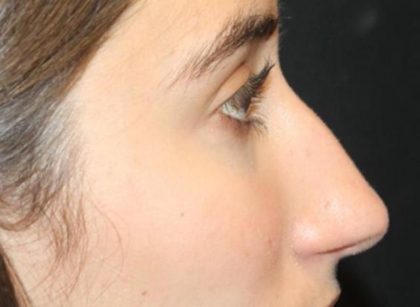 Rhinoplasty Before & After Patient #30321