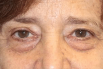 Blepharoplasty Before & After Patient #30271