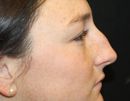 Rhinoplasty Before & After Patient #30305