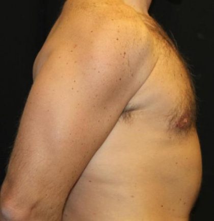 Gynecomastia Before & After Patient #30330