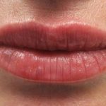 Lip Filler Before & After Patient #30316
