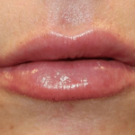 Lip Filler Before & After Patient #30298