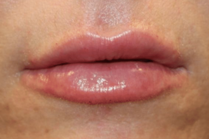 Lip Filler Before & After Patient #30298