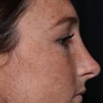 Rhinoplasty Before & After Patient #30305