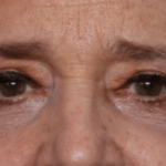 Blepharoplasty Before & After Patient #30271