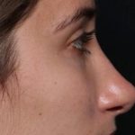 Rhinoplasty Before & After Patient #30321