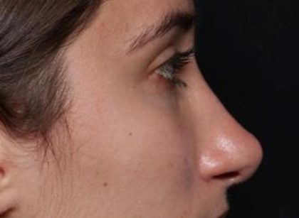 Rhinoplasty Before & After Patient #30321