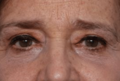 Blepharoplasty Before & After Patient #30271