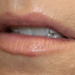 Lip Filler Before & After Patient #30298