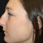 Rhinoplasty Before & After Patient #30305