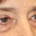 Blepharoplasty Before & After Patient #30271