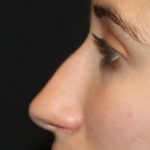 Rhinoplasty Before & After Patient #30321
