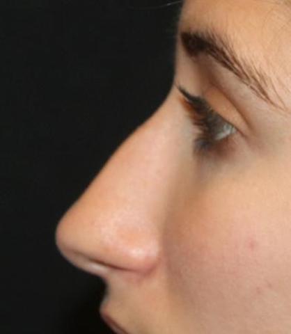 Rhinoplasty Before & After Patient #30321