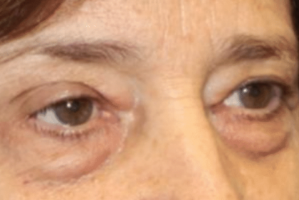 Blepharoplasty Before & After Patient #30271