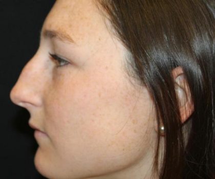 Rhinoplasty Before & After Patient #30305