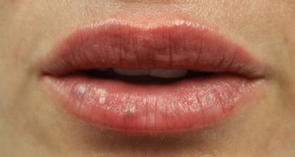 Lip Filler Before & After Patient #30316