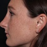 Rhinoplasty Before & After Patient #30305