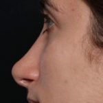 Rhinoplasty Before & After Patient #30321
