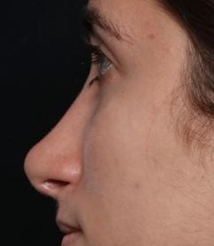 Rhinoplasty Before & After Patient #30321