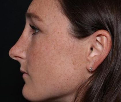 Rhinoplasty Before & After Patient #30305