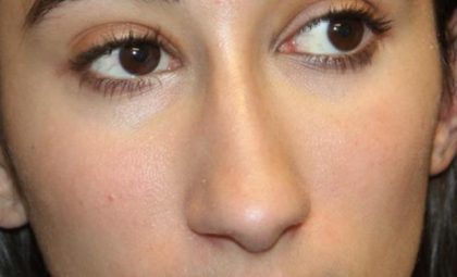 Rhinoplasty Before & After Patient #30321