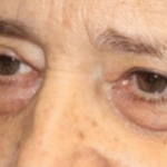 Blepharoplasty Before & After Patient #30271