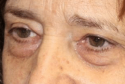 Blepharoplasty Before & After Patient #30271